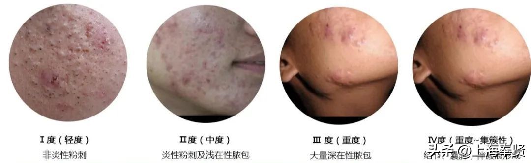 只要青春不要“痘”！解决青春烦恼方法多丨贤医健康说