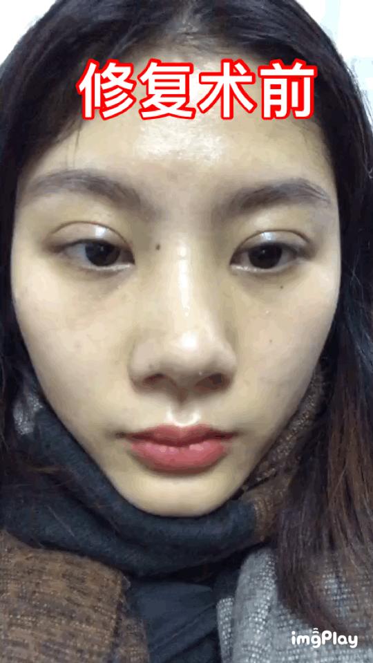 双眼皮贴导致眼皮破了,双眼皮贴导致眼皮严重下垂恢复