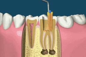 一颗牙齿补牙2600,年纪轻轻补牙补了六颗