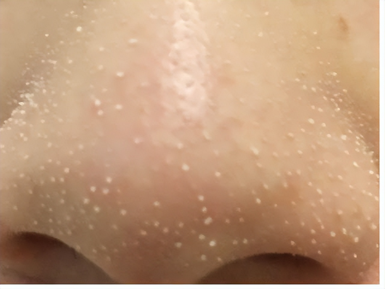 清洁面膜可以去黑头粉刺闭口吗,清洁面膜可以去除黑头吗