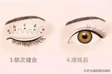 埋线双眼皮眼部淤青很厉害怎么办,埋线双眼皮没有那么明显了怎么办