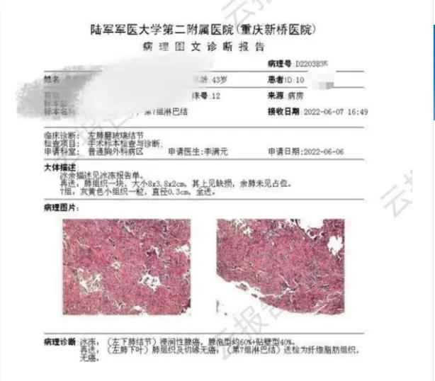 肾癌切除后七年发现软组织结节,肾癌切除后发现结节