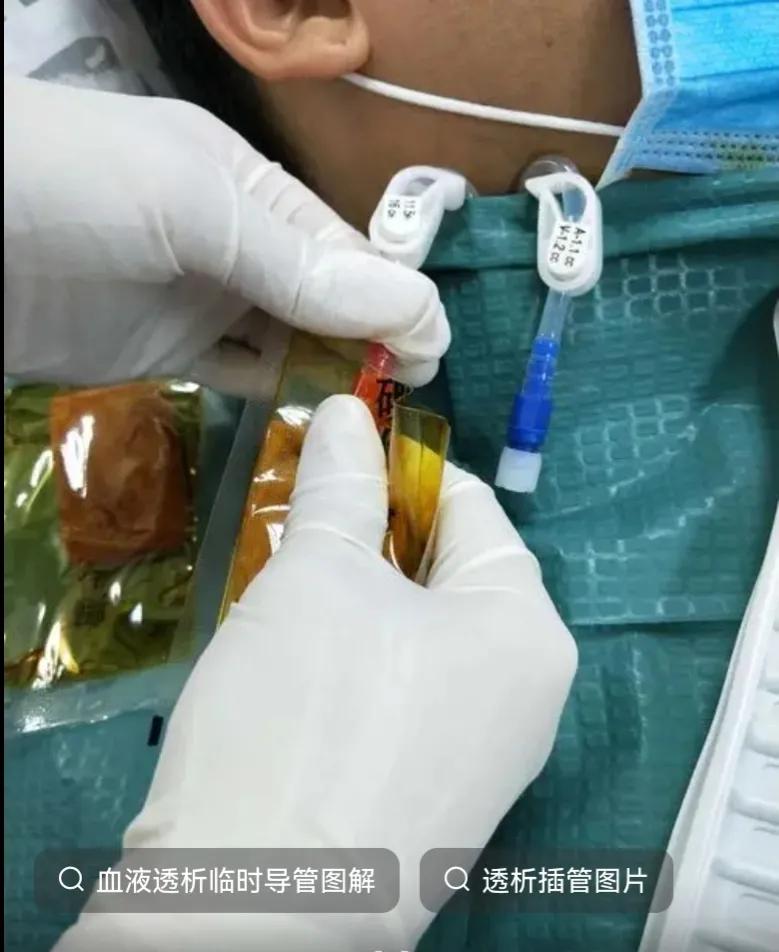 血管通路维护的意义,血管通路护理是怎样工作的