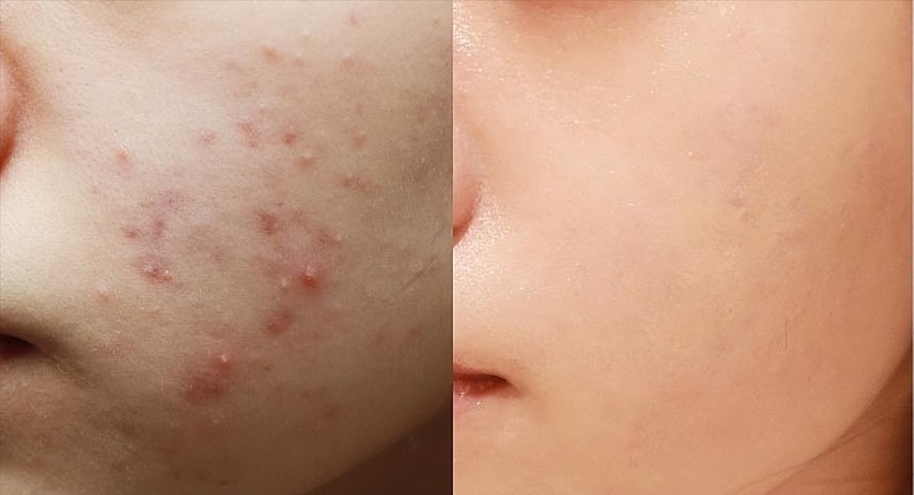 皮肤科医生用维a酸抗皱,权威专家谈维a酸对皮肤的作用