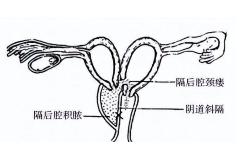 24岁女孩检出两个阴道，还有双子宫？医生解答，详细告诉你怎么办