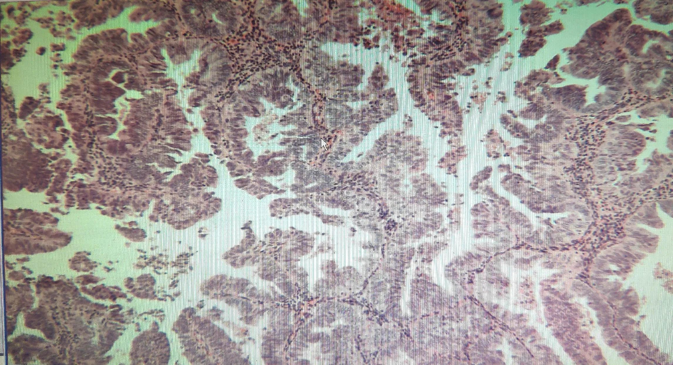 子宫内膜癌肥胖,27岁患子宫内膜癌能治愈吗