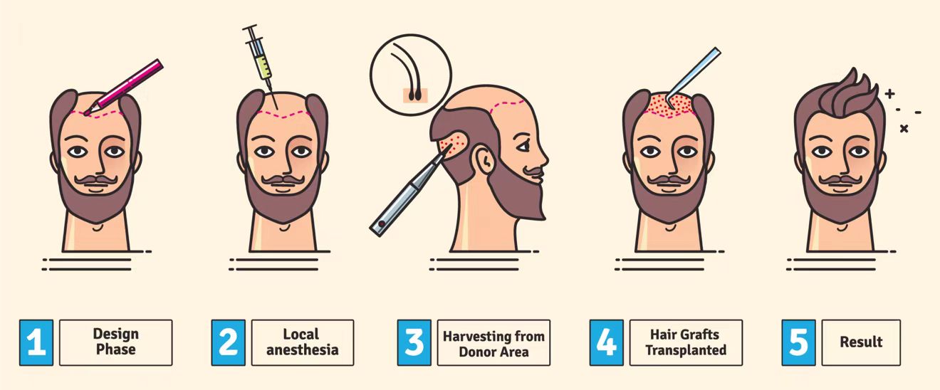 毛发移植,毛发移植能维持多久