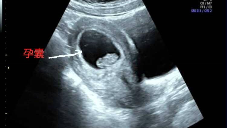 药流伤身,药流副作用大还是人流副作用大