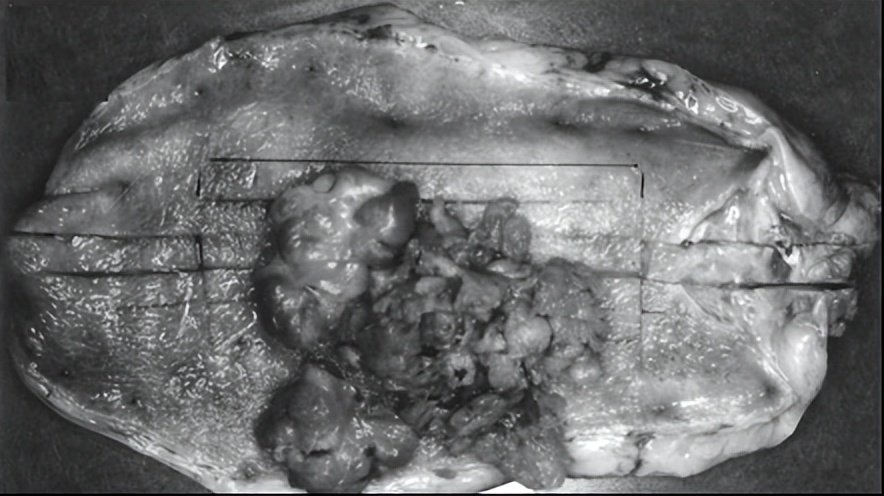 胆囊多发息肉样病变8mm*6mm,胆囊息肉病变0.6严重吗能喝酒吗