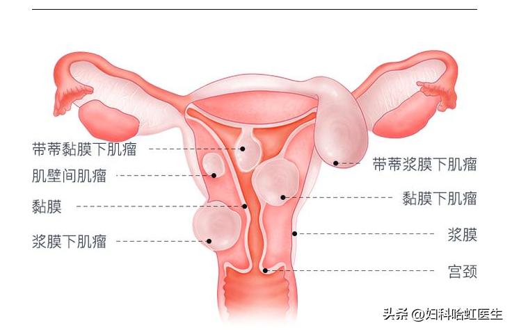 女性得子宫肌瘤能看好吗,女性肌瘤有必要治吗
