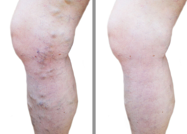 左腿静脉血栓最好的解决方案,右下肢静脉血栓可能是癌症吗