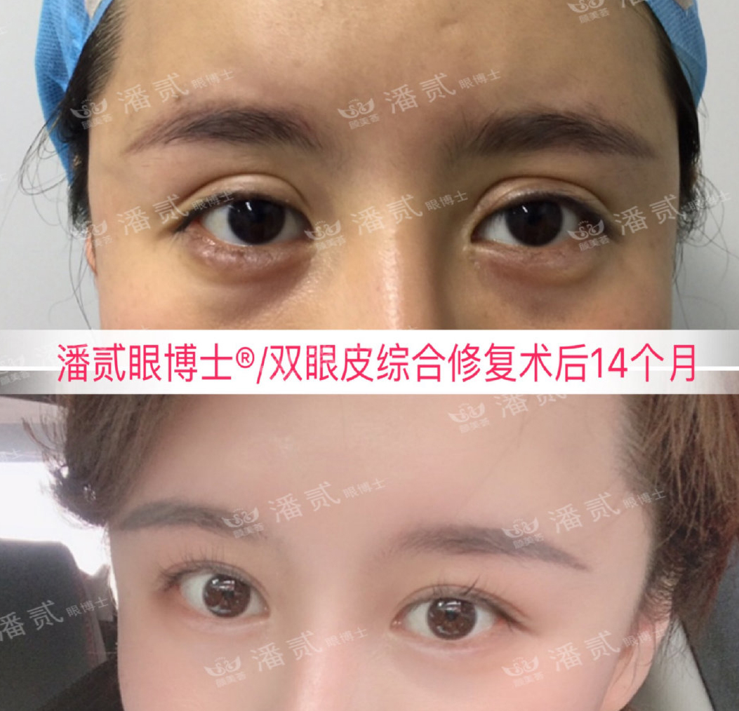 在整形医院割双眼皮多少钱,整形一般做双眼皮多少钱