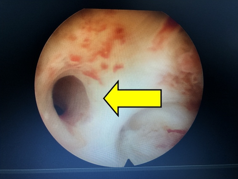宫寒卵巢早衰月经量少怎样调理,月经量越来越少是要绝经了吗