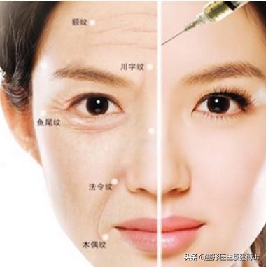 停止打玻尿酸脸会松弛下垂吗,停止打溶脂针后会怎样