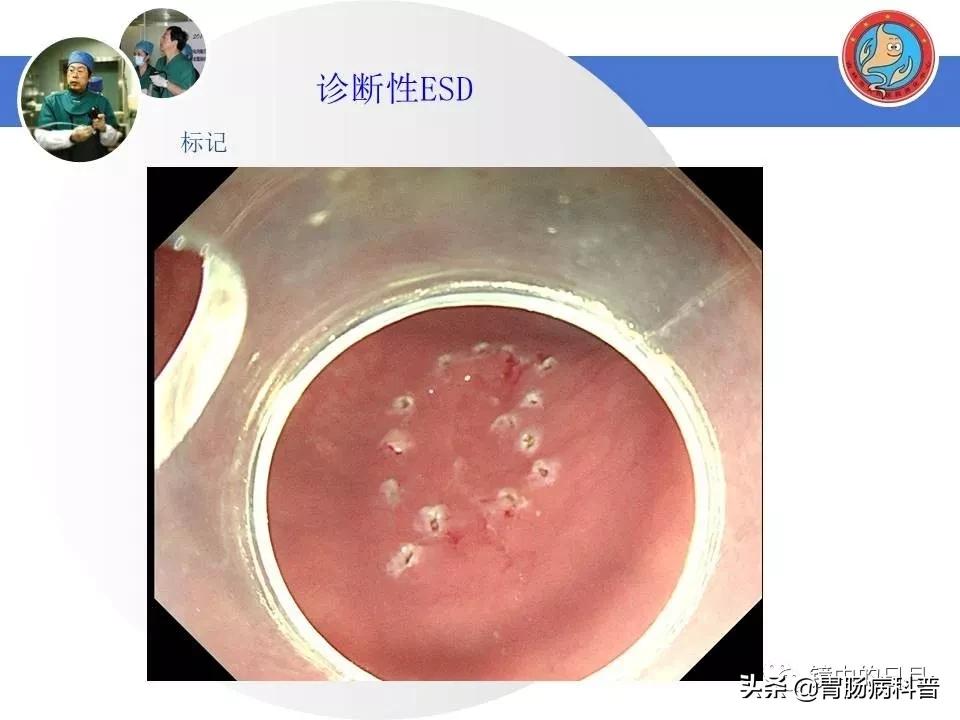 胃癌可以做内镜手术吗,早期胃癌内镜手术后追加外科手术