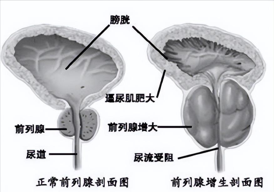 经尿道前列腺等离子切除术,TUPKRP
