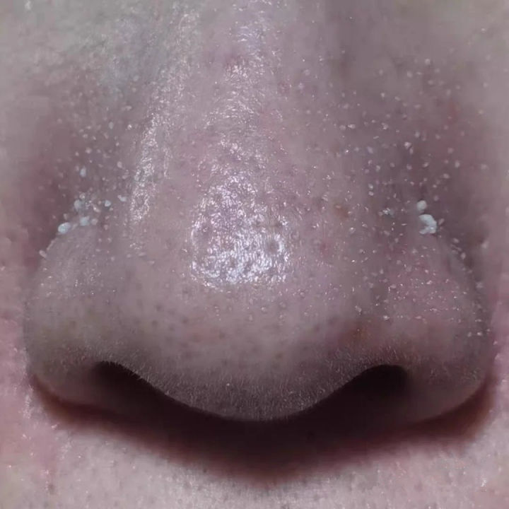 黑头没挤干净怎么办,黑头没及时处理变成黑痣了怎么办