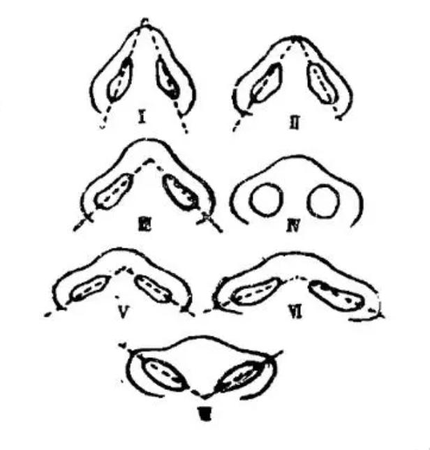 隆鼻以后鼻孔外露算是失败吗,露鼻孔的鼻子怎么隆鼻