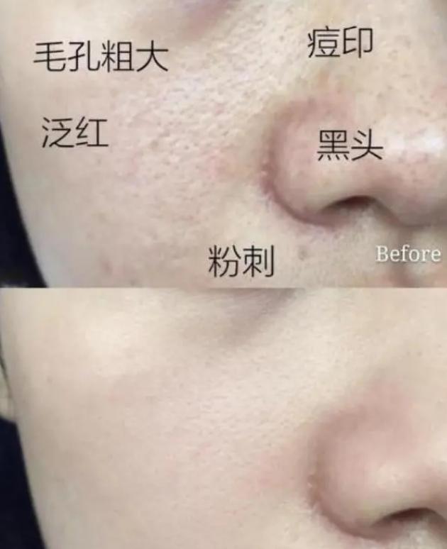 硫磺皂洗脸后皮肤刺痛感怎么办,经常用硫磺皂洗脸对皮肤有影响吗