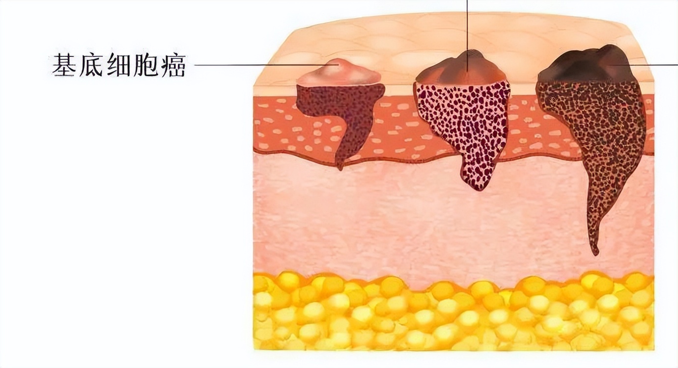 头上长了红色斑要注意了,头上有斑块怎么治