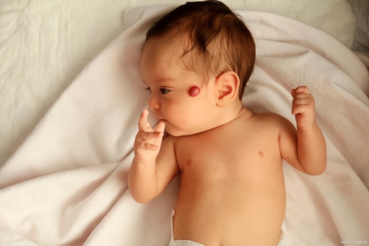 宝宝血管瘤要怎么样治疗,宝宝血管瘤该怎么治疗呢