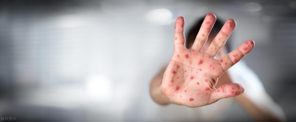 妈妈60岁了手上有好多斑点是什么,妈妈66岁额头上长了很多横纹