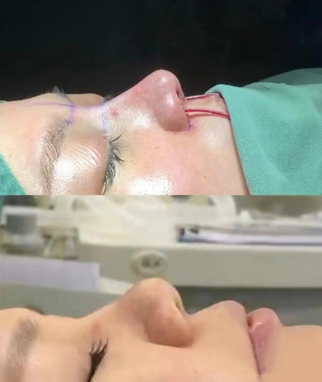 猪鼻整形手术,鼻头肥大鼻子整形成功案例