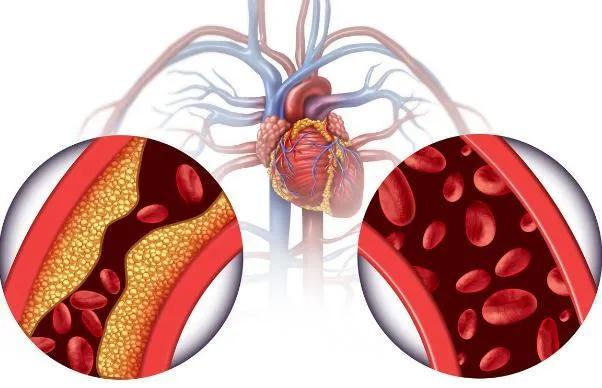 同型半胱氨酸26严重吗 (你不知道同型半胱氨酸有多可怕)