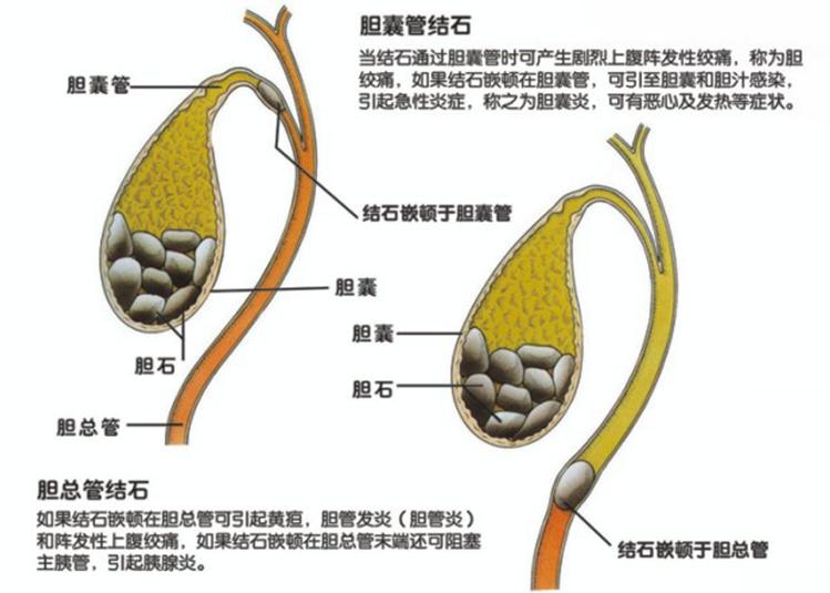 为什么胆有结石必须摘了,胆结石医生为什么都建议割胆