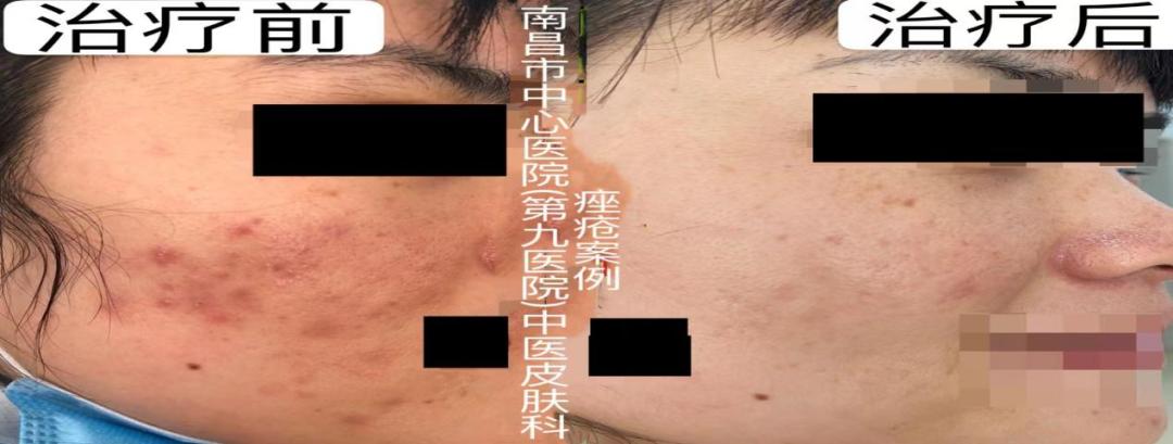 想拥有光滑无痘的脸，别再做这个动作了