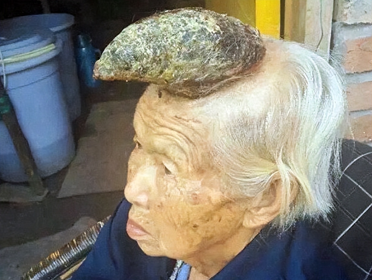 112岁老人头上长犄角,107岁老人头上有个长犄角