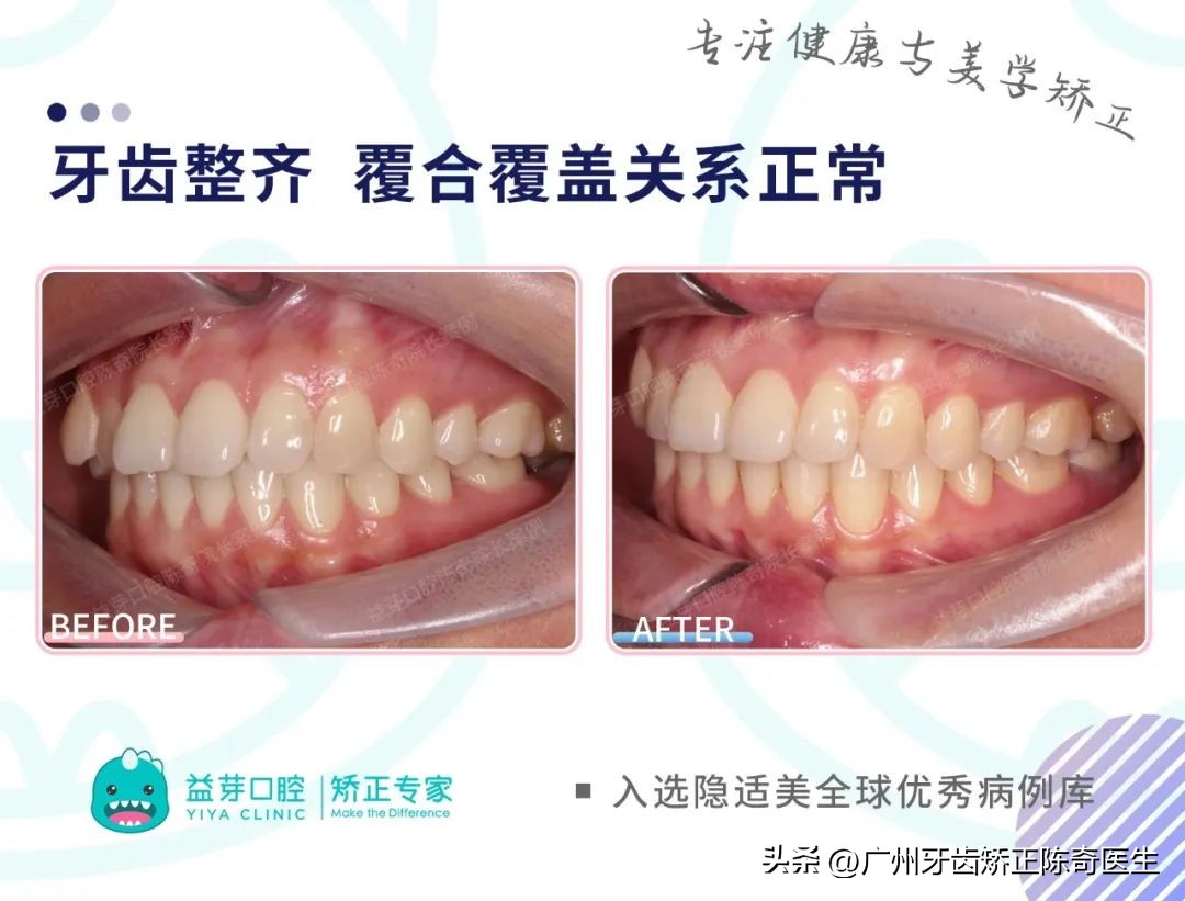 正畸治疗的基本矫治方法,正畸修复联合案例