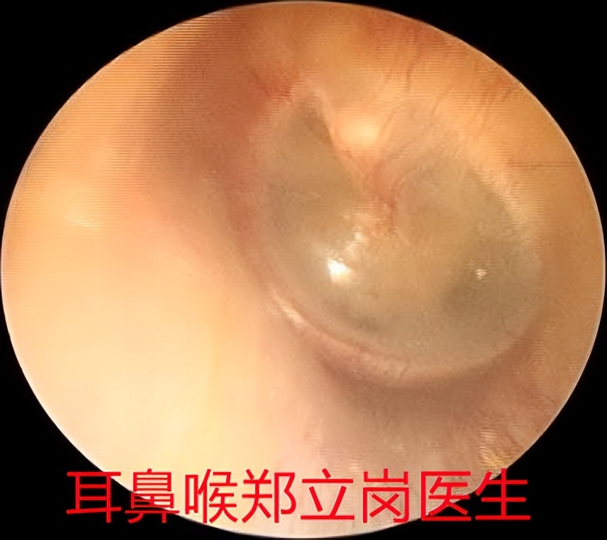 突然耳聋堵塞是怎么回事,耳朵痒听力下降有堵塞感