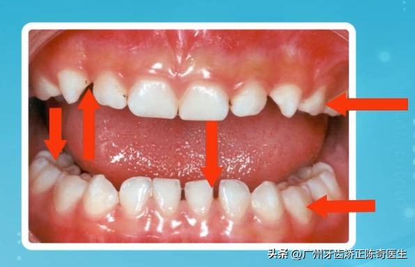 小孩子大牙蛀牙严重怎么办,为啥有的小孩满嘴蛀牙都掉完了