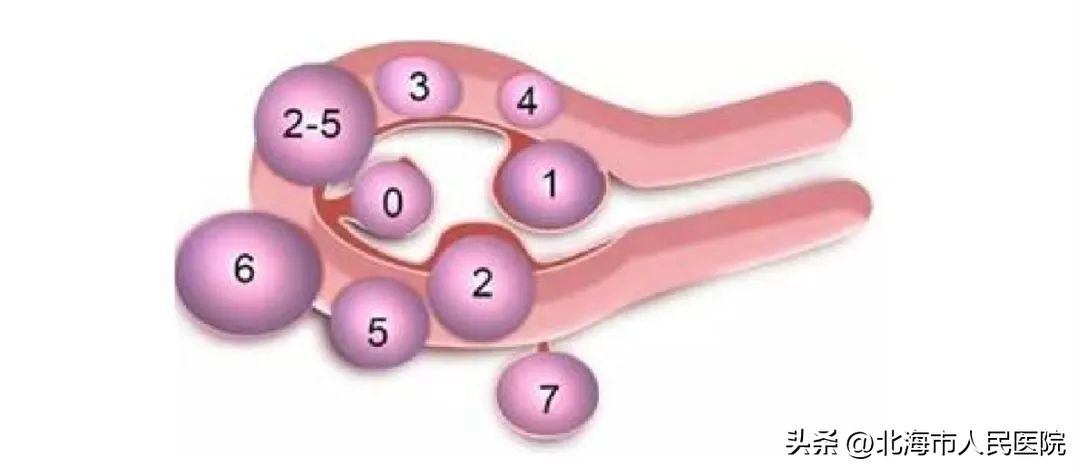 子宫肌瘤做不干净会怎么样,子宫肌瘤为什么不能做盆底修复