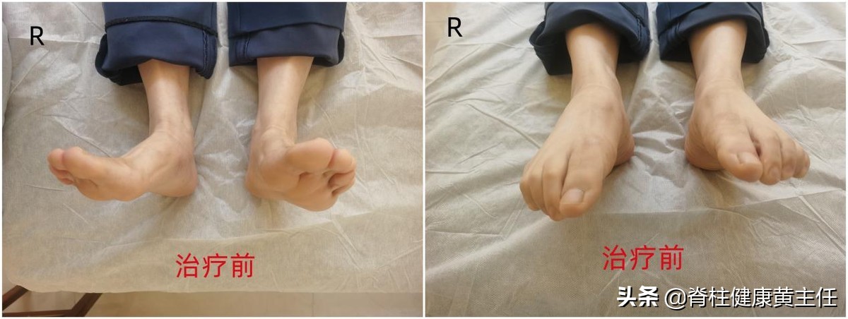踝关节损伤疼痛一招搞定,踝关节受损的康复治疗方法