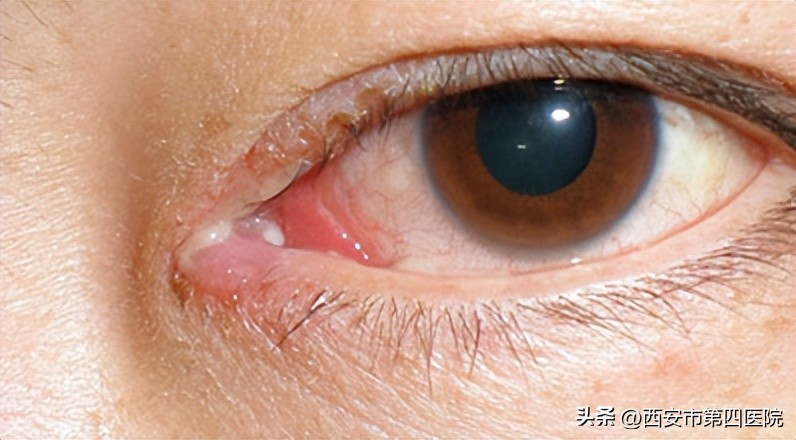 泪小管堵塞有眼屎正常吗,泪小管发炎出眼屎吗