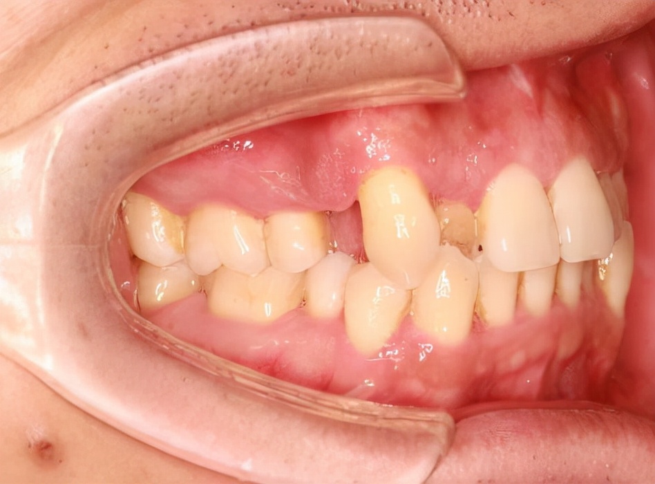 年轻人缺一两颗牙要管吗？真要管