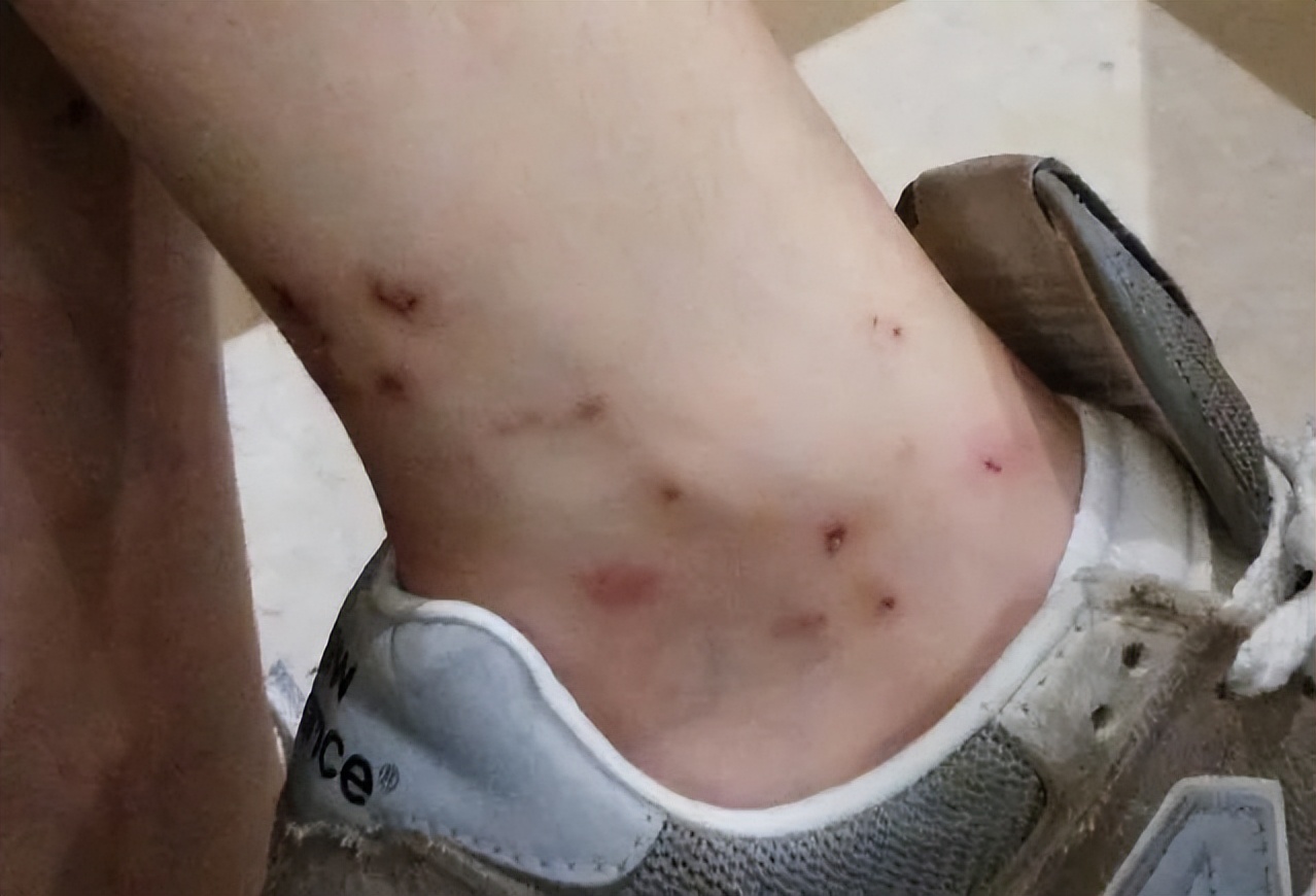 黑色蚊子咬完怎么处理,蚊子咬包留下黑色印子