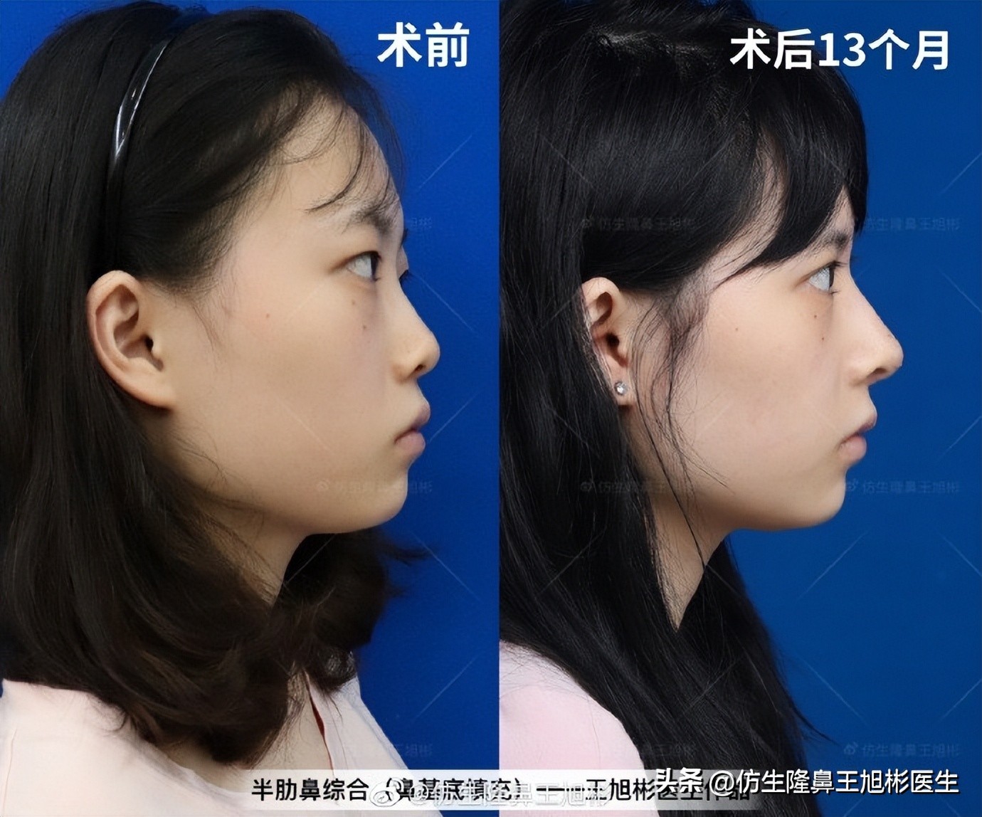 鼻基底填充会移位到鼻孔吗,鼻基底填充假体会拉长人中吗