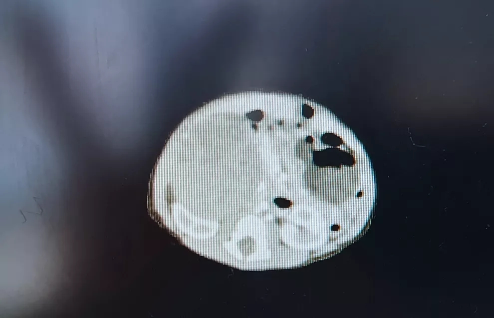 新生儿肾母细胞瘤3.4厘米,50天婴儿脑部长肿瘤66mm