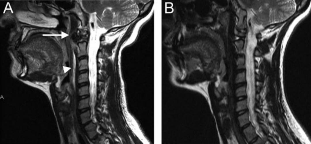 颈长肌腱炎影像表现,三头肌钙化性肌腱炎治疗
