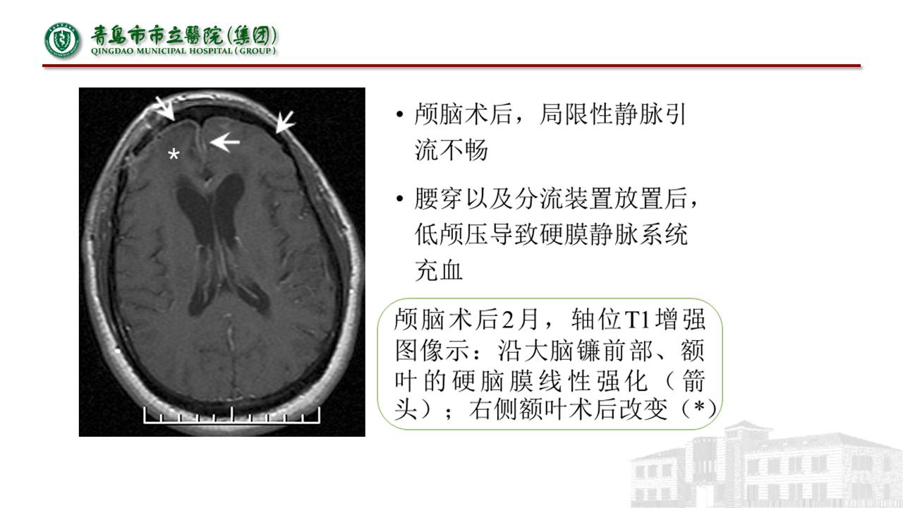 低颅压综合征耳闷,低颅压综合征吃什么药