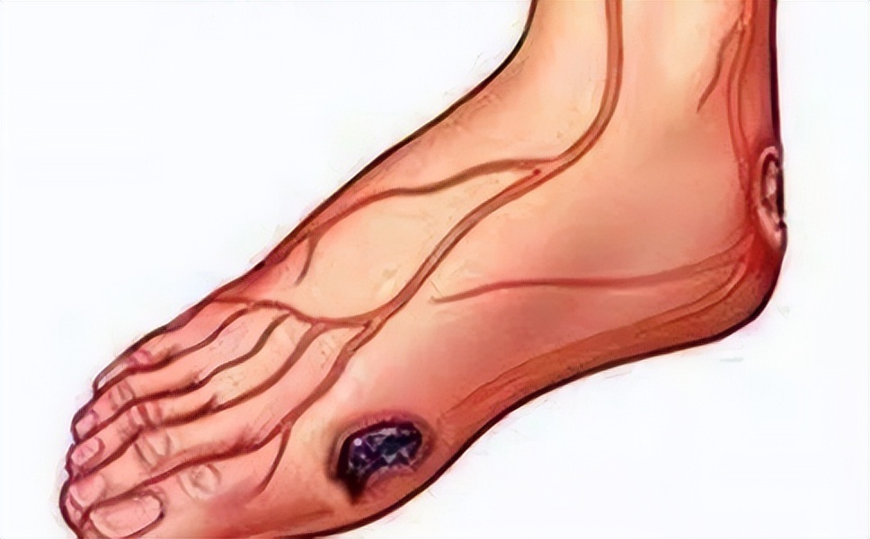 脉管炎症状示意图,请问脉管炎的临床表现有哪些啊