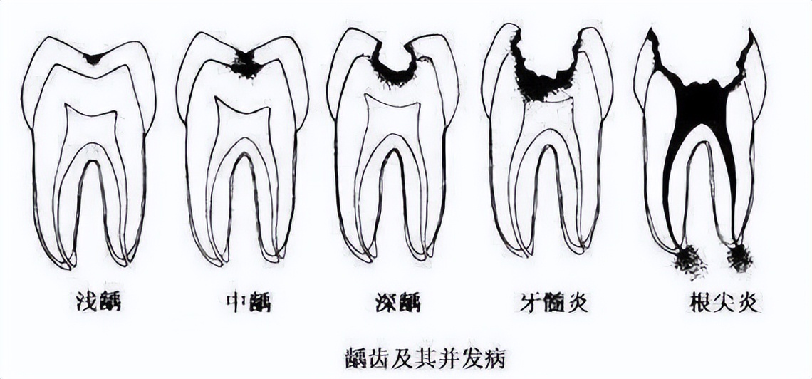 儿童换牙前龋齿有必要治疗吗,龋齿不疼不痒要根管吗
