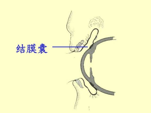 治疗青光眼的复合眼药水,乙酰唑胺治疗青光眼怎么吃