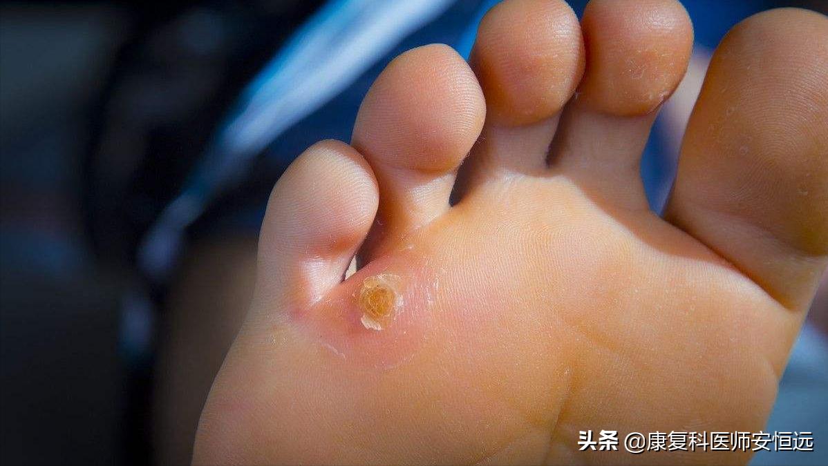 脚底板爱发烫是什么原因,脚底板生茧很疼怎么回事