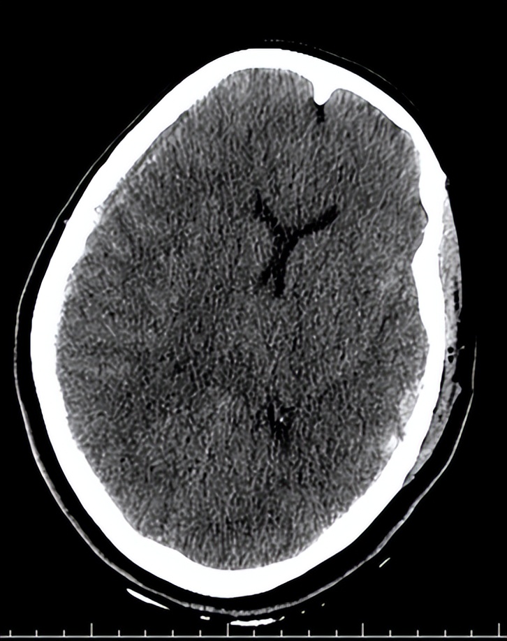 医院成功救治重型颅脑患者,特重型颅脑损伤治愈案