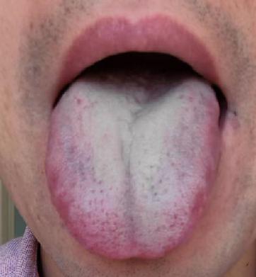 湿热难以清除4个中成药清湿热,十大祛湿热的中成药