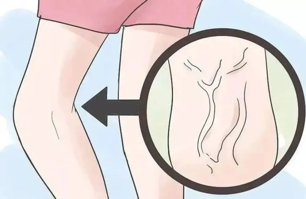 微创无疤！沣东院区完成首例腔内注射硬化剂微创治疗大隐静脉曲张